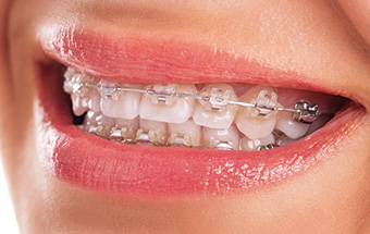 Orthodontics-Braces
